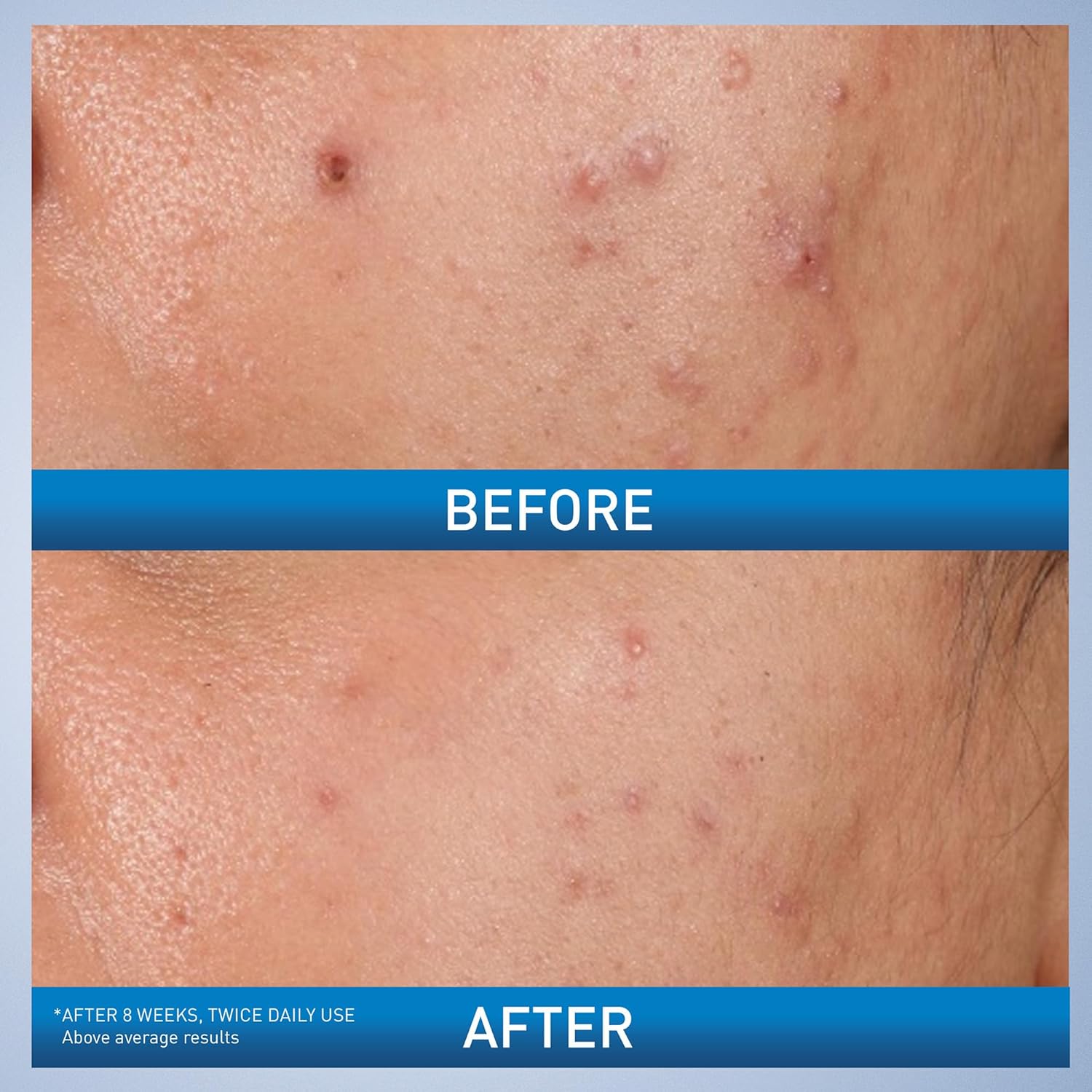 cerave-acne-cream-default-title-cerave-acne-control-gel-2-salicylic-acid-acne-treatment-40ml-43132099821807.jpg