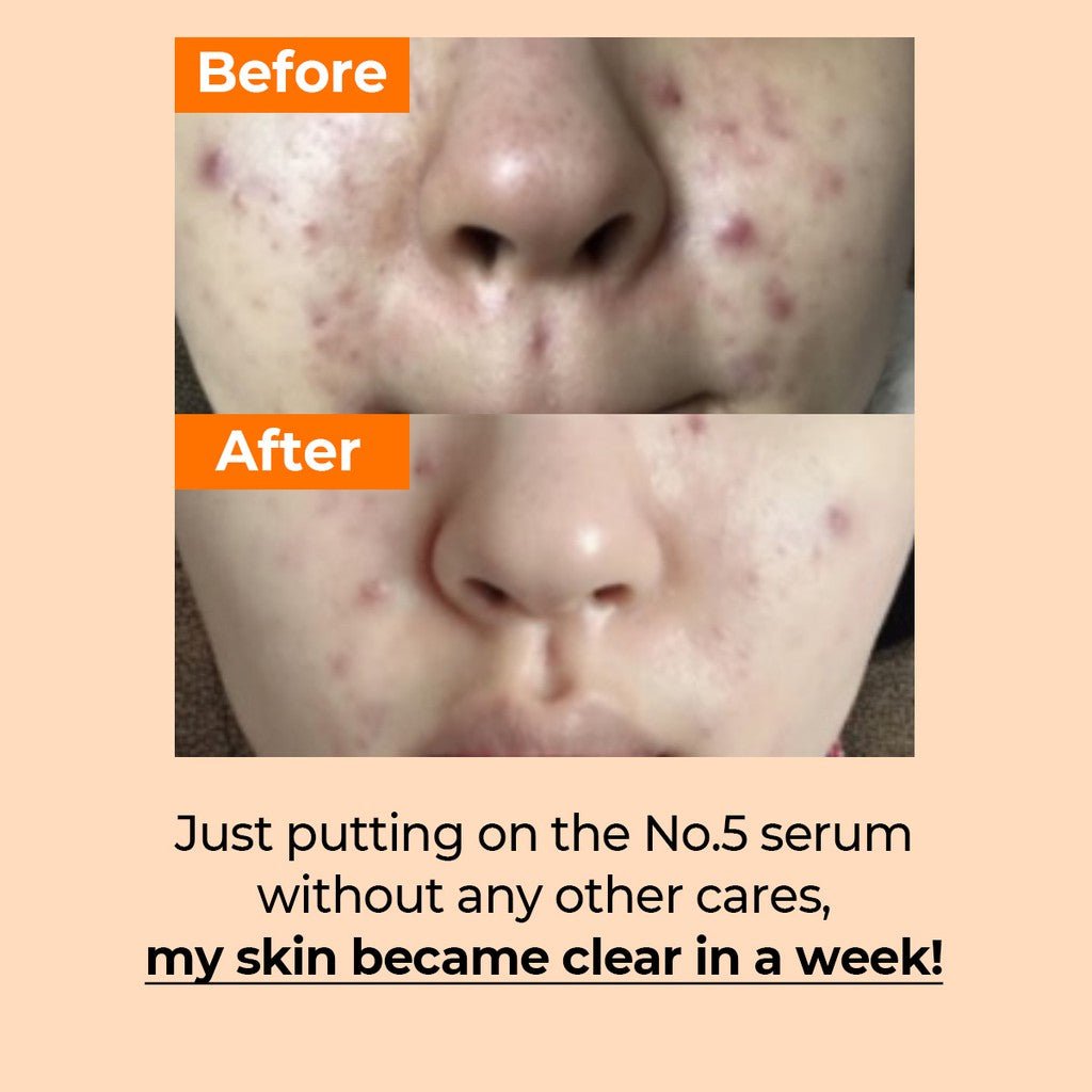 numbuzin-serum-default-title-numbuzin-no-5-goodbye-blemish-serum-50ml-40791082860783.jpg