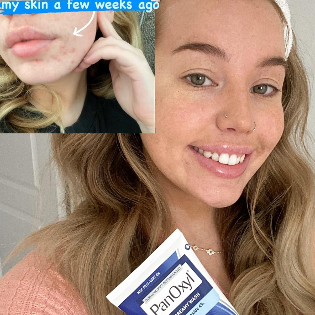 panoxyl-acne-cream-default-title-panoxyl-acne-creamy-wash-4-benzoyl-peroxide-daily-control-170g-40576362053871.jpg
