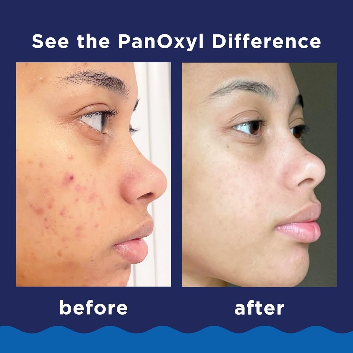 panoxyl-foaming-wash-default-title-panoxyl-acne-foaming-wash-42396686418159.jpg